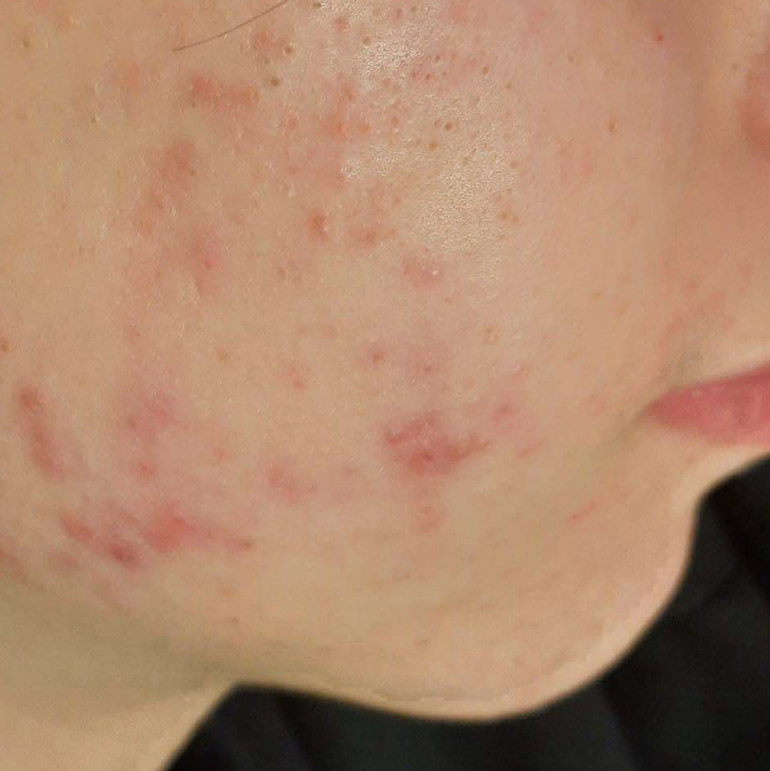 Mavex Sebo Balance anti-acne line