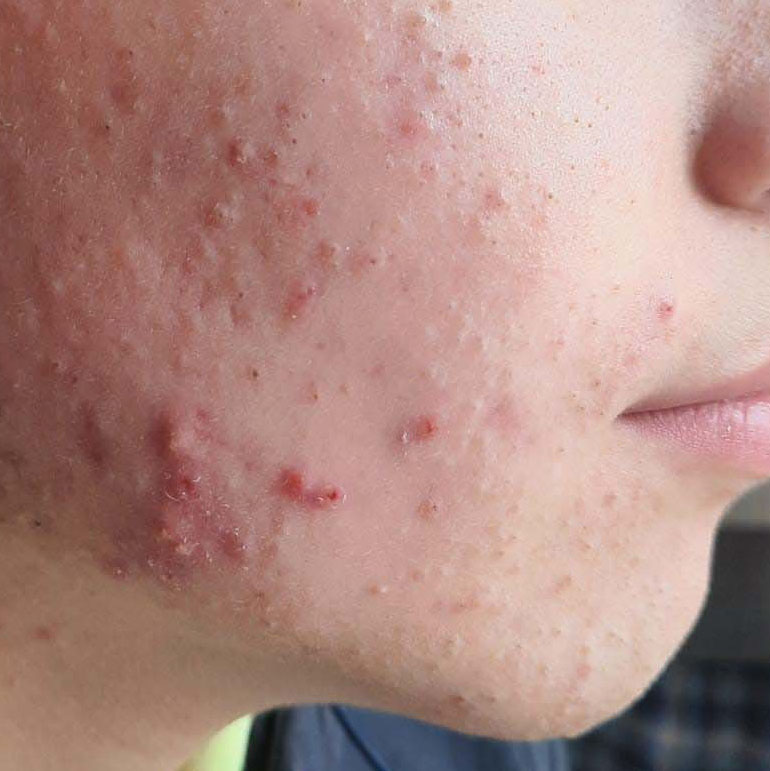 Mavex Sebo Balance anti-acne line