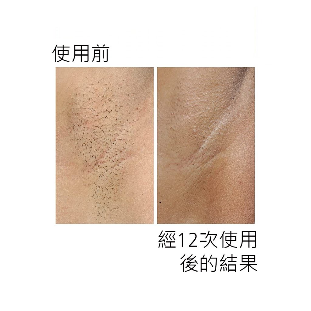 SmoothSkin Pure Fit IPL 彩光脫毛機 黑色